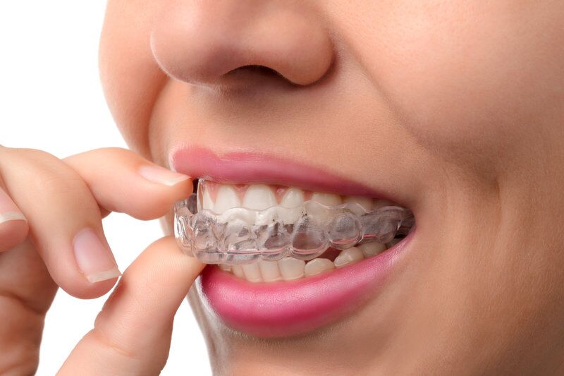 Best Aligners and Braces in Indirapuram